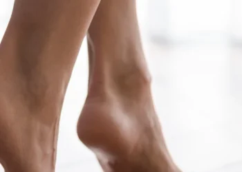 Illustration of Flatfoot with hindfoot valgus